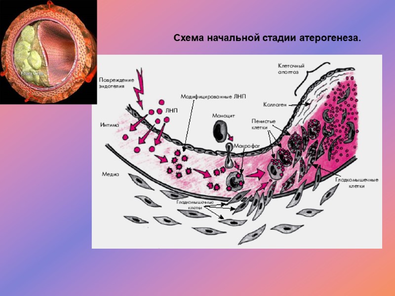 Схема начальной стадии атерогенеза.